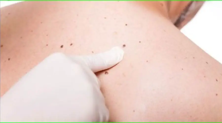 The Meaning of Lucky Moles on the Female body
