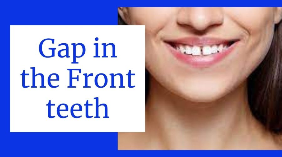 Gap Between Front Teeth: Find Out whether the Gap Between Front teeth is lucky or not!