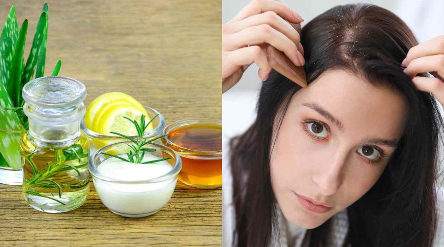 Know These Home Remedies for Dandruff | Dandruff Treatment at Home