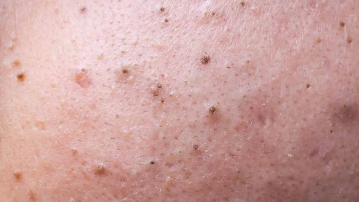 Know the 6 Types Of Pimples and Their Treatments Seed in the Pimple