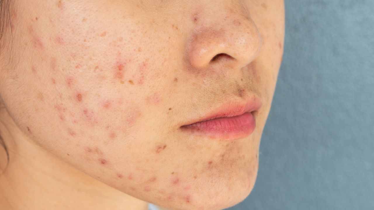 Know the 6 Types Of Pimples and Their Treatments Seed in the Pimple