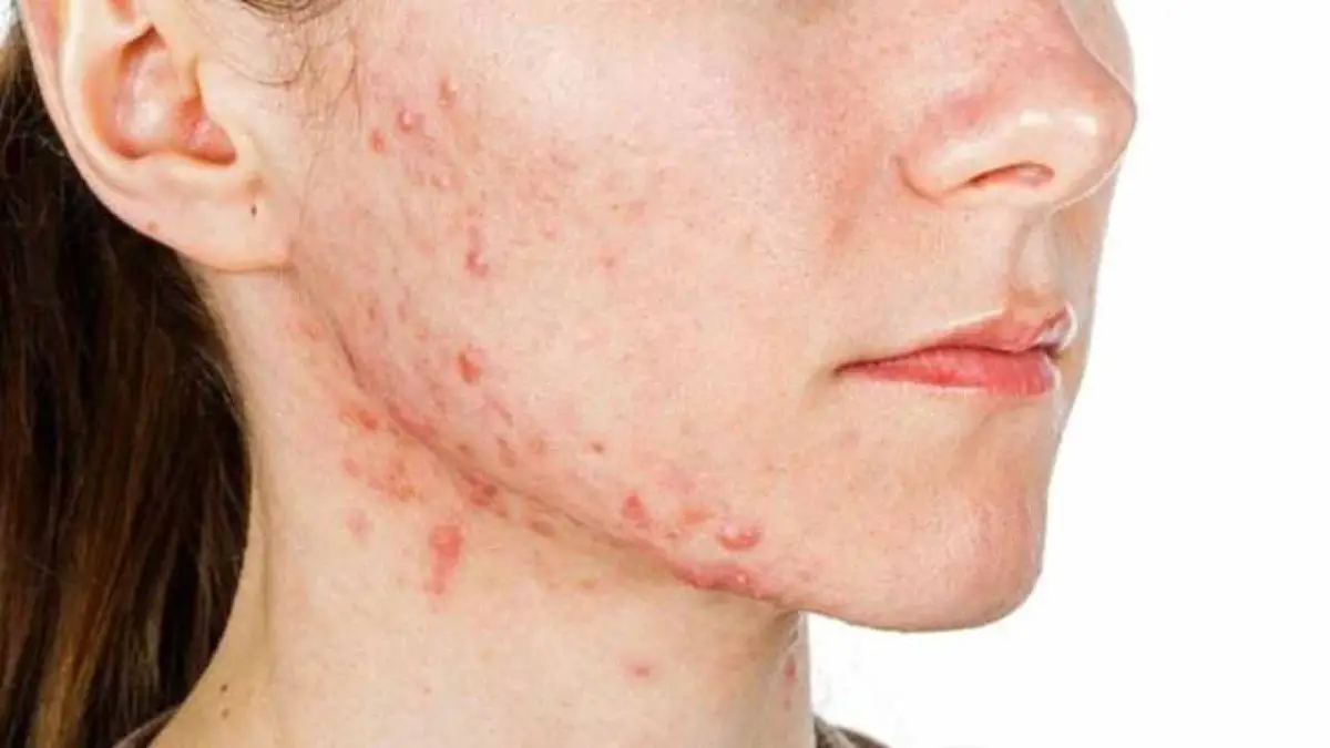 Know the 6 Types Of Pimples and Their Treatments Seed in the Pimple