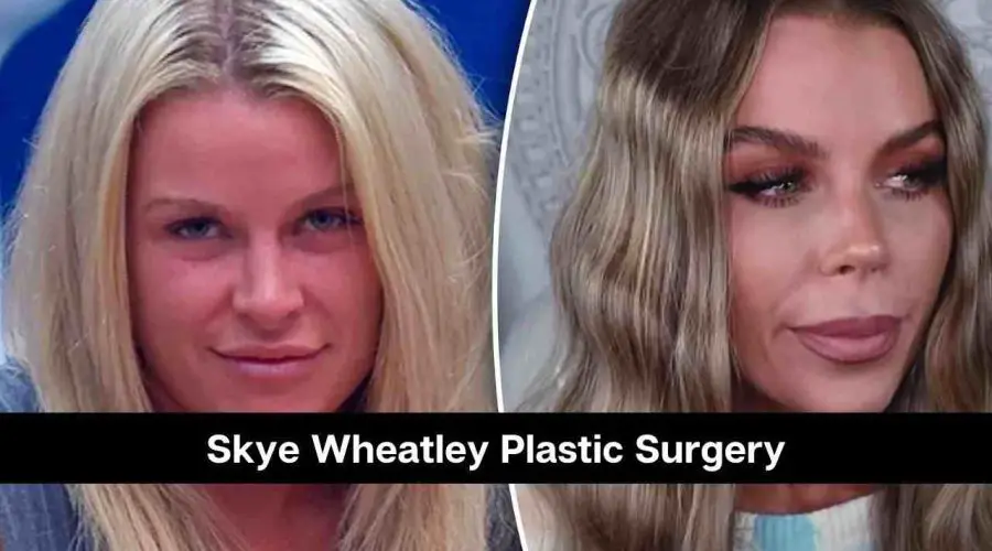 Big Brother Star Skye Wheatley Plastic Surgery: Know About Her Transformation